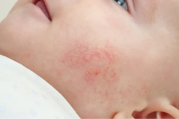 Zmiana o charakterze atopowym na policzku niemowlęcia. 